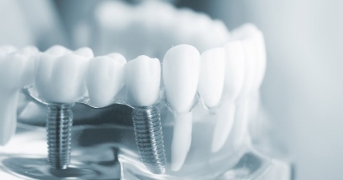 Türkiye’de Diş İmplant Tedavisinin Avantajları ve Fiyatları